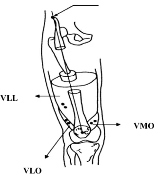 FIGURA 4: Colocação dos eletrodos ativos de superfície nos músculos VMO, VLL e VLO. 