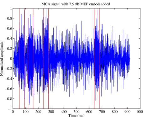 Figure 3.2: Simulated MCA blood flow signal with added 7.5 dB MEP emboli The time-domain representation of the simulated emboli is formed by a  sinu-soidal wave which frequency is retrieved from the corresponding embolus area time interval of the averaged 