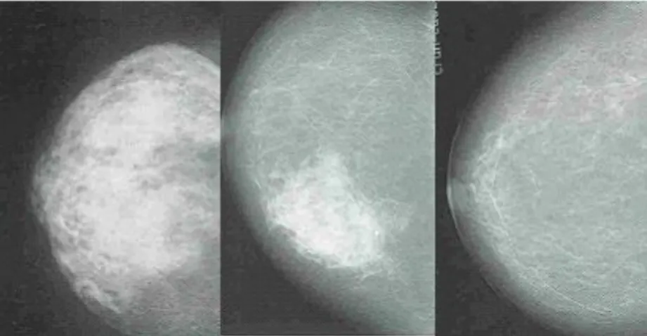Figura 7 – Classificação da mama: mama fibroglandular, mama fibroadiposa, mama adiposa  (Fonte: Bontrager) 