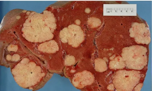 Figura 1. Fotografia do corte de um fígado com múltiplos nódulos provenientes  de um cancro pancreático