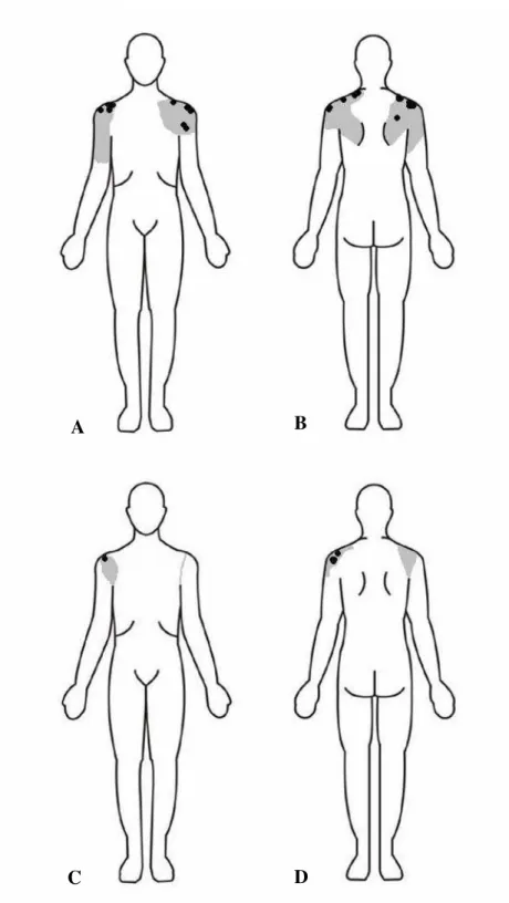 Figura 1: Localização anterior e posterior da área de dor em 14 trabalhadores com síndrome do impacto  nos períodos pré-intervenção (A e B, respectivamente) e pós-intervenção (C e D, respectivamente)