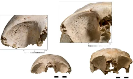 Figura  10.  Cribra  orbitália  do  tipo  porótico  (crânio  direito;  sepultura  15  IM/1894)  e  cribrótico (crânio esquerdo; sepultura 3 IM/3371)