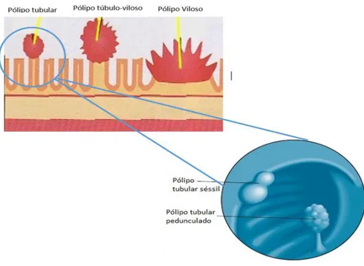 Figura 3.6- Anatomia dos pólipos pediculados ou sésseis, com histologia tubular, túbulo-vilosa  ou vilosa