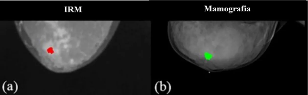 Figura 7.2.1 – Comparação de imagens por ressonância magnética (a) e por mamografia (b) de  uma senhora de 54 anos com cancro da mama ductal invasivo, em que é visível a maior 