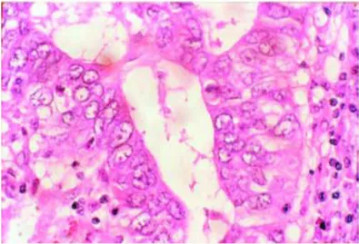 Figura 3 - Adenocarcinoma pulmonar (adaptado de  11 ) 