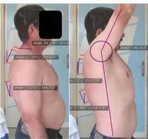 Fig. 1 Angular measurements performed with the  arms at rest (left) and at full shoulder flexion (right),  showing the upper and lower thoracic spine angles (º) 
