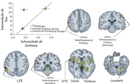 Figura 4.2 - Neuroimagens onde se observa o maior fluxo sanguíneo cerebral regional  em doente com FM, como resposta aos estímulos aplicados durante o exame de dor