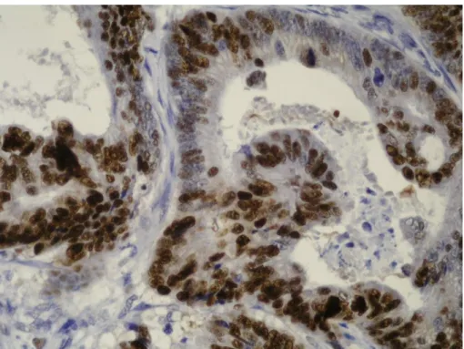 Figura  7  –  Amostra  de  adenocarcinoma  colorretal  com  75%  das  células  positivas  para  a  marcação  imunohistoquímica