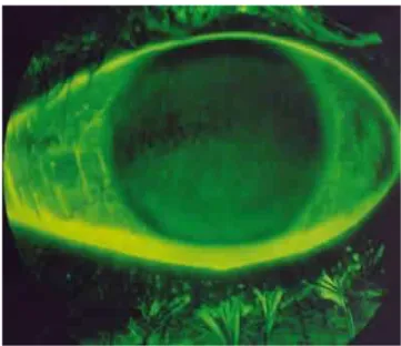 Figura 2.6. Observação da superfície corneal após instilação de Fluoresceína (teste BUT)