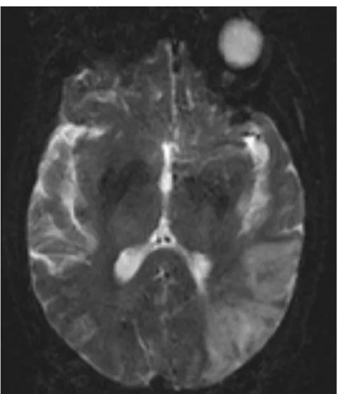 Ilustração 1 - RM do paciente 2 onde é visível a lesão parieto-temporo-occipital esquerda sugestiva  de isquémia