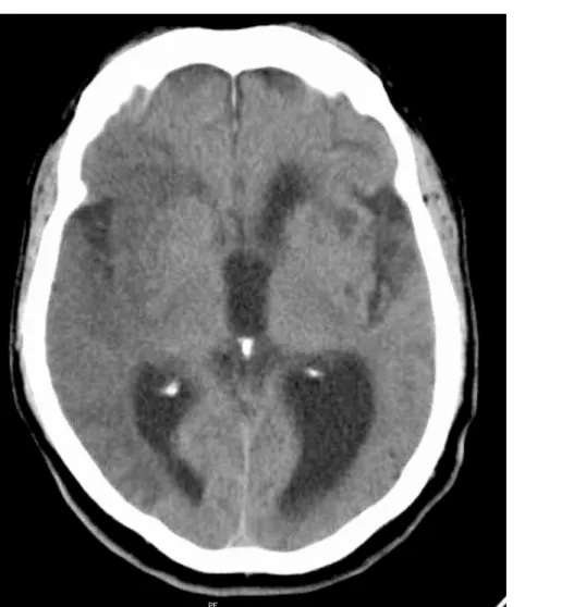 Figura 3 - Traçado de EEG do paciente 3 com início de uma crise epileptiforme de localização  fronto-parietal direita