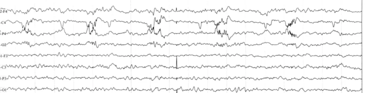 Figura 5 – Continuação do traçado de EEG do paciente 3 que mostra o padrão ponta-onda à direita