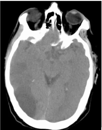 Figura  6 - Traçado  de  EEG  do  paciente  4  que  mostra  o  predomínio  da  actividade  lenta  do  hemisfério direito relativamente ao esquerdo