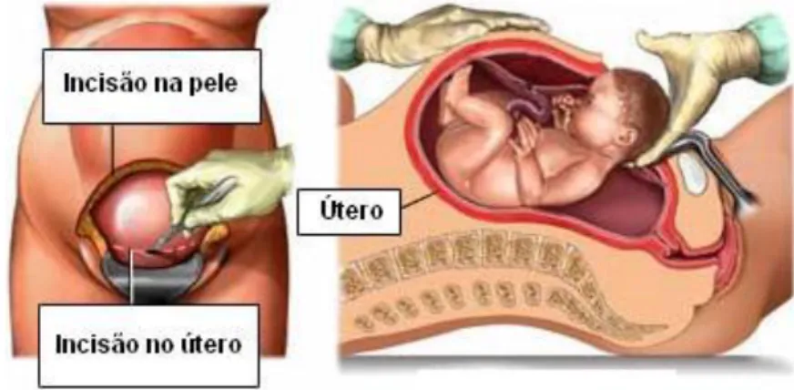 Figura  1.5  –  Representação  do  parto  cirúrgico  com  incisão  do  abdómen  e  do  útero  materno  (cesariana)
