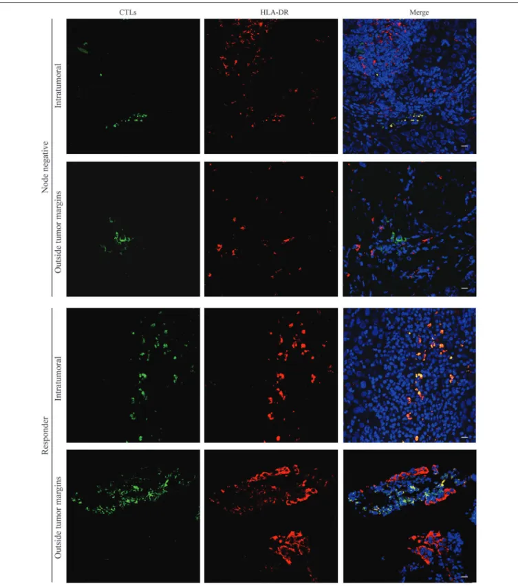 FIGURE 3 | HLA-DR-expressing CTLs are localized in intraepithelial tumor structures of patients without axillary lymph node metastasis and in NACT responders.