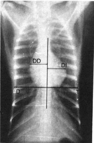 FIGURA 1.  Radbgrafia  que muestra las mediines  usadas para calcular el índi  cardiotorácico