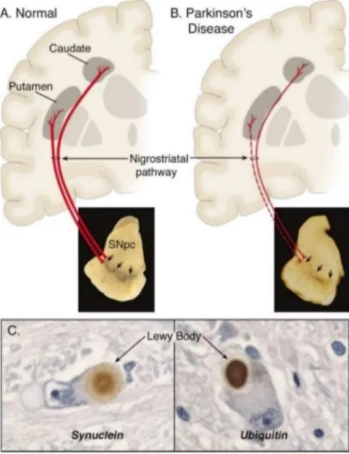 Figure  1-  Schematic  representation  of  PD  hallmarks.  (A)  In  a  normal  nigrostriatal  pathway  the  pigmentation of the SNpc produced by neuromelanin within the DA neurons is projected to the ST