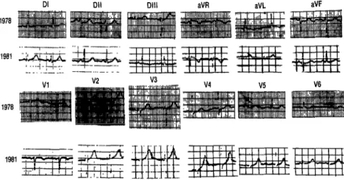 FIGURE 1.  In 1978 the ECG tracings of a Group B woman 25 years old revealed an evident left  anterior hemiblrxk