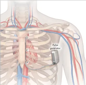 Fig. 12 – Localização dos componentes de um Cardioversor-Desfibrilhador Subcutâneo (Modelo LGen-S8)