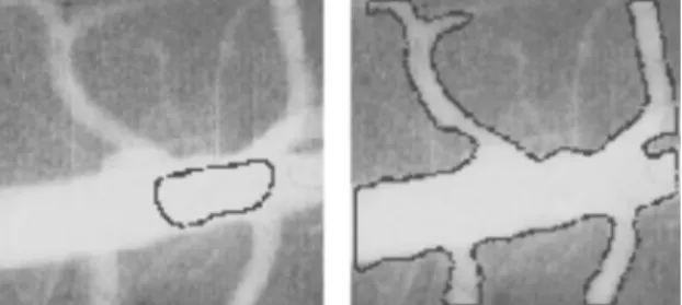 Figure 16: Level Set Segmentation: Original image on the left, Level-Set segmented image on the right