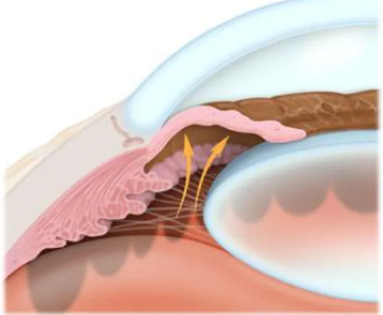 Ilustração 14. Imagem esquematizando o glaucoma de ângulo fechado  Fonte: http://www.efei.com/eye_disease.html 