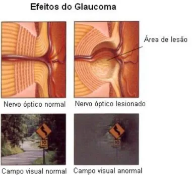 Ilustração 16. Alteração da visão com o glaucoma  Adaptado de: http://www.fishmanvision.com/glaucoma_management