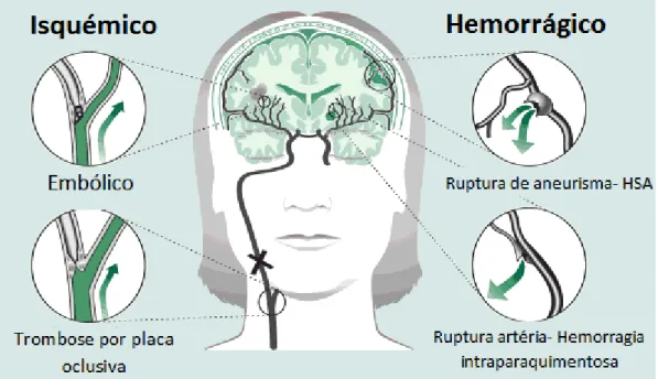 Figura 1- Patogénese do AVC isquémico e hemorrágico- Modificado de ”Hypertension and Stroke” 