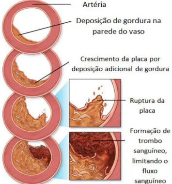 Figura 2- - Processo gradual de formação de uma placa de ateroma, que interrompe o fluxo  sanguíneo - Modificado de http://www.sparrow.org/HealthLibrary/Content.aspx?DocID=DS00525