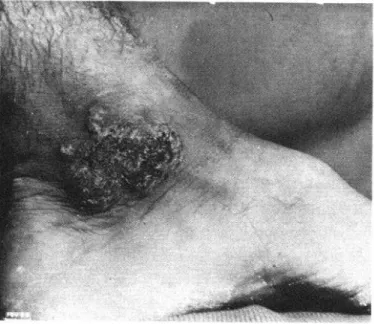 Figure  1.  Caser  of  successful  treatment  of  chromoblastomycosis  with  54luorocytosine