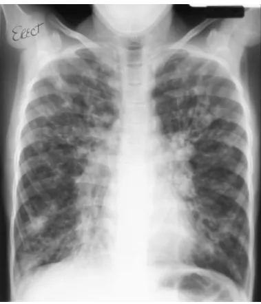 Fig.  2 [8]  – Radiografia  do  tórax  em  doente  com  FQ,  demonstrando  doença  intersticial  com  bronquiectasias e densidades nodulares por condensação mucóide.