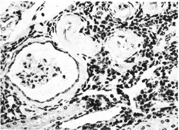 FIGURA  l-Corte  de  un  rifión  de  armadillo  que  muestra  un  marcado  espesamiento  de  lo  cópsula  de  Bowman  (a  la  derecha)  e  infiltración  intersticial  linfoide  (a  la  iz-  quierda)