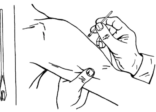 Figure  1.  Vaccination  with  the  bifurcated  needle. 