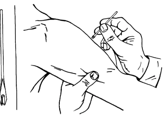 Figure  1.  Vaccination  with  the  bifurcated  needle. 