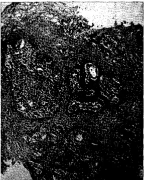 Figure  5.  Adrenal  gland  with  Caseous  necrosis  and abundant  yeast  celis.  H-E