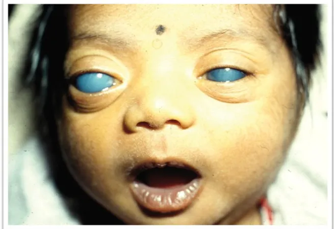 Figura 6 - Criança com glaucoma congénito bilateral(22) 