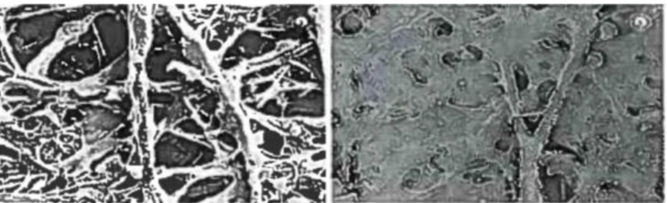 Figura 7 - Malha trabecular normal (esquerda) e num doente glaucomatoso (direita) (14)