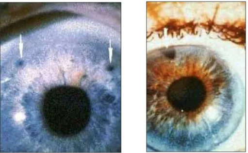 Figura 9 - Iridotomia (esquerda) e iridectomia (direita) (imagem gentilmente cedida por Clínica  Oftalmológica das Antas – Porto) 