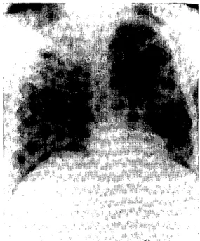 FIGURE  2.  X-rays  of  the  four  known  BK-positive  cases  in  the  Xingu  area
