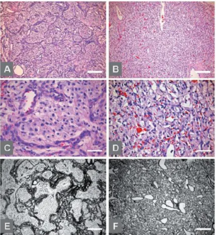 Figura  5  -  Variantes  celular  (A,  C  e  E)  e  reticular  (B,  D  e  F)  do  hemangioblastoma