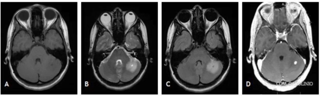 Figura  9  -  Imagens  de  RM-CE  de  outubro  de  2008  que  mostram  a  lesão  do  hemisfério  cerebeloso  esquerdo