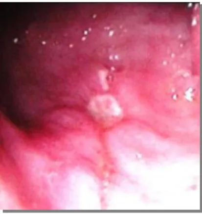 Figura 1.1: Imagem endoscópica de uma úlcera gástrica do antro  (16)