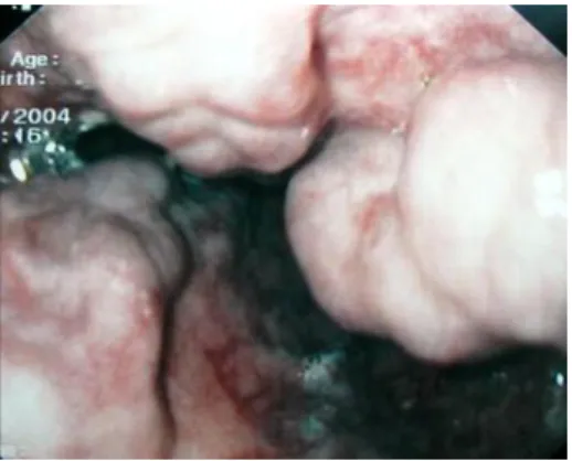 Figura 1.2: Imagem endoscópica de varizes esofágicas de grandes dimensões  (17)
