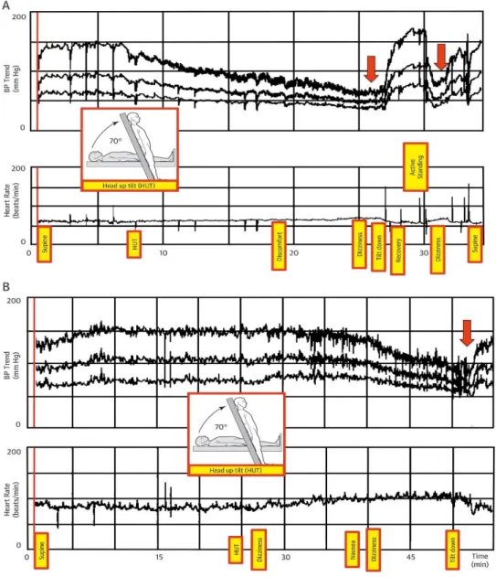 Figura 5. Traçados durante um Head-up teste de Tilt realizado em dois pacientes protótipos com perda  transitória  da  consciência