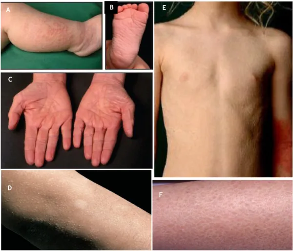 Figura  1  –  Manifestações  clínicas  de  IV.  (A)  Bebé  com  IV  e  eczema  concomitante(12); (B)  Bebé  com  hiperlinearidade plantar(12); (C)  Hiperlinearidade palmar em doente do sexo feminino de 40 anos(12); 