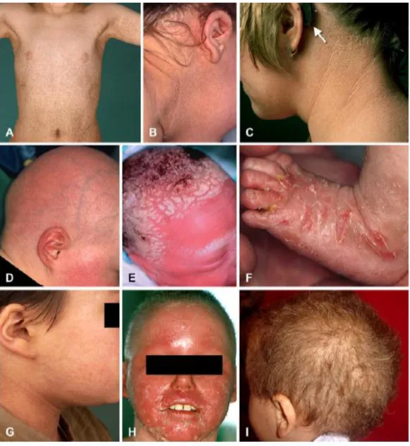 Figura 8 – Manifestações clínicas de algumas ictioses sindromáticas. (A) TTD; (B) Síndrome de Sjögren- Sjögren-Larsson(6); (C) Síndrome KID(6);  (D) Síndrome IFAP(6); (E) Síndrome de Prematuridade com Ictiose(6); 