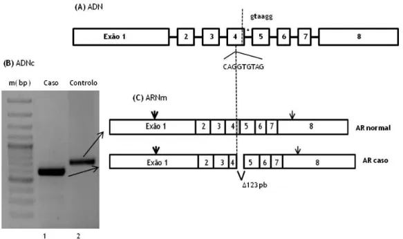 Figura 6. Localização da mutação no local de doação de splicing e esquema do consequente evento de  splicing aberrante