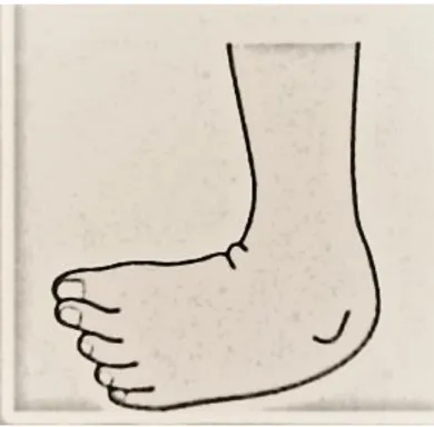 Figure 10 Abnormal foot contact, from (Levine, Richards, &amp; Whittle, 2012)