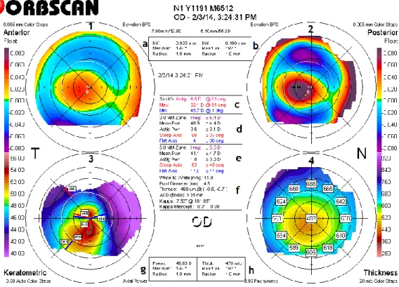 Figura  8:  Orbscan  do  OD.  Os  quatro  mapas  no  sentido  horário,  a  partir  do  canto  superior  esquerdo  incluem  o  mapa  de  elevação  anterior  (1),  de  elevação  posterior  (2),  o  mapa  de  poder  axial  (3)  e  paquimetria (4)