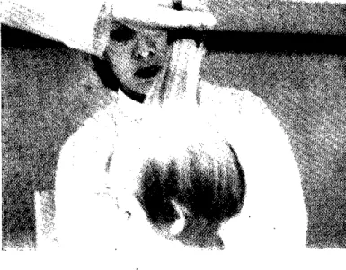 Figura  5  - « Signo  de  bandera »:  alternación  de  bandas claroas  y  oscuras  en  el  cabello  de  un  niño  rubio  (Costa Rica)  que  presenta  un  síndrome  leve  pero  con  receados.