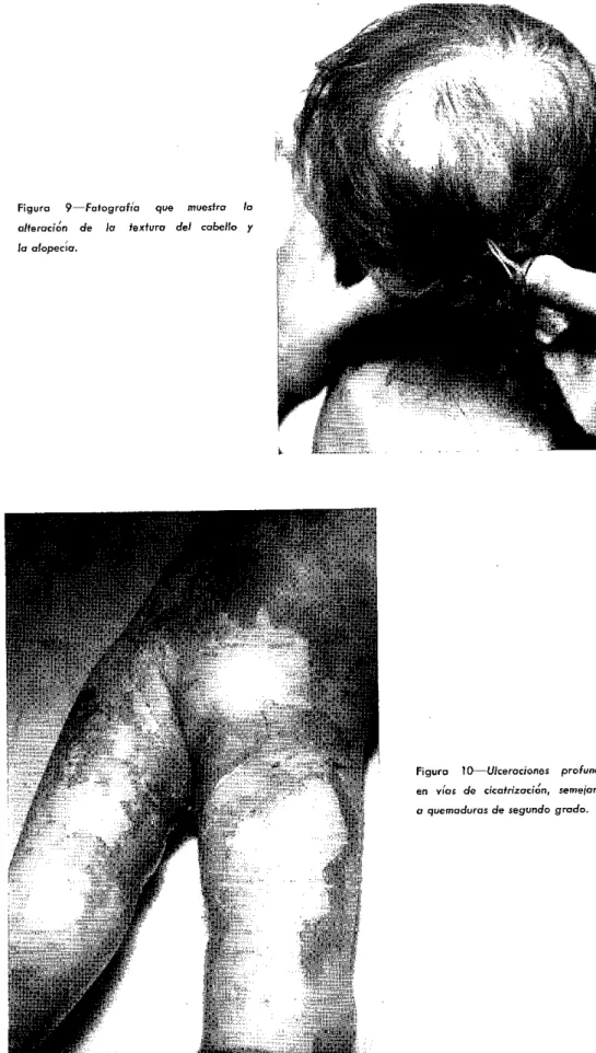 Figura  10-Ulceraciones  profunda en  v[as  de  cicatrización,  semejante a  quemaduras  de  segundo  grado.